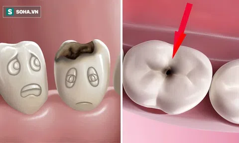 Chuyện gì sẽ xảy ra nếu bạn có một chiếc răng sâu và không chịu chữa trị ngay?