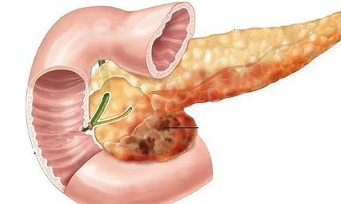 Sốt, đau bụng đi kèm các dấu hiệu này: Hãy cảnh giác cao độ với bệnh ung thư tuyến tụy