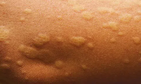 Giải mã bí ẩn của dị ứng và sốc phản vệ: Điều gì đã đánh sập cả cơ thể chỉ trong vài phút?