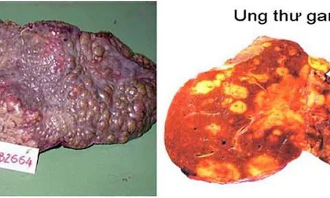 5 nguyên nhân khiến người Việt mắc và chết vì ung thư gan cao thứ 4 thế giới